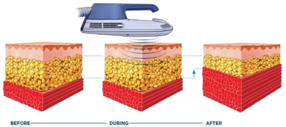 illustration of how emsculpt machine works