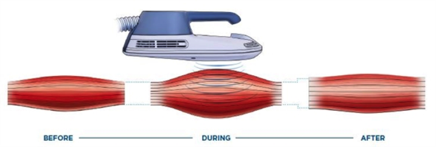 non-invasive butt lift using emsculpt