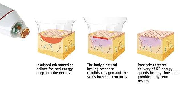 diagram of how genius microneedling​ works