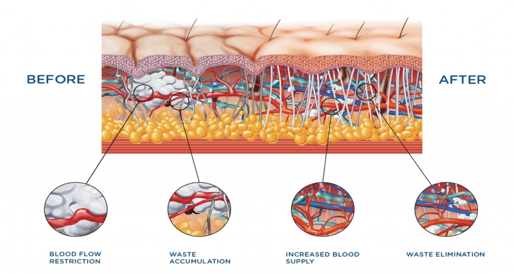 before and after cellutone procedure