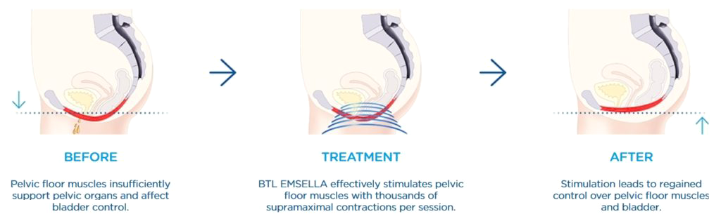 graphic of the process of emsella