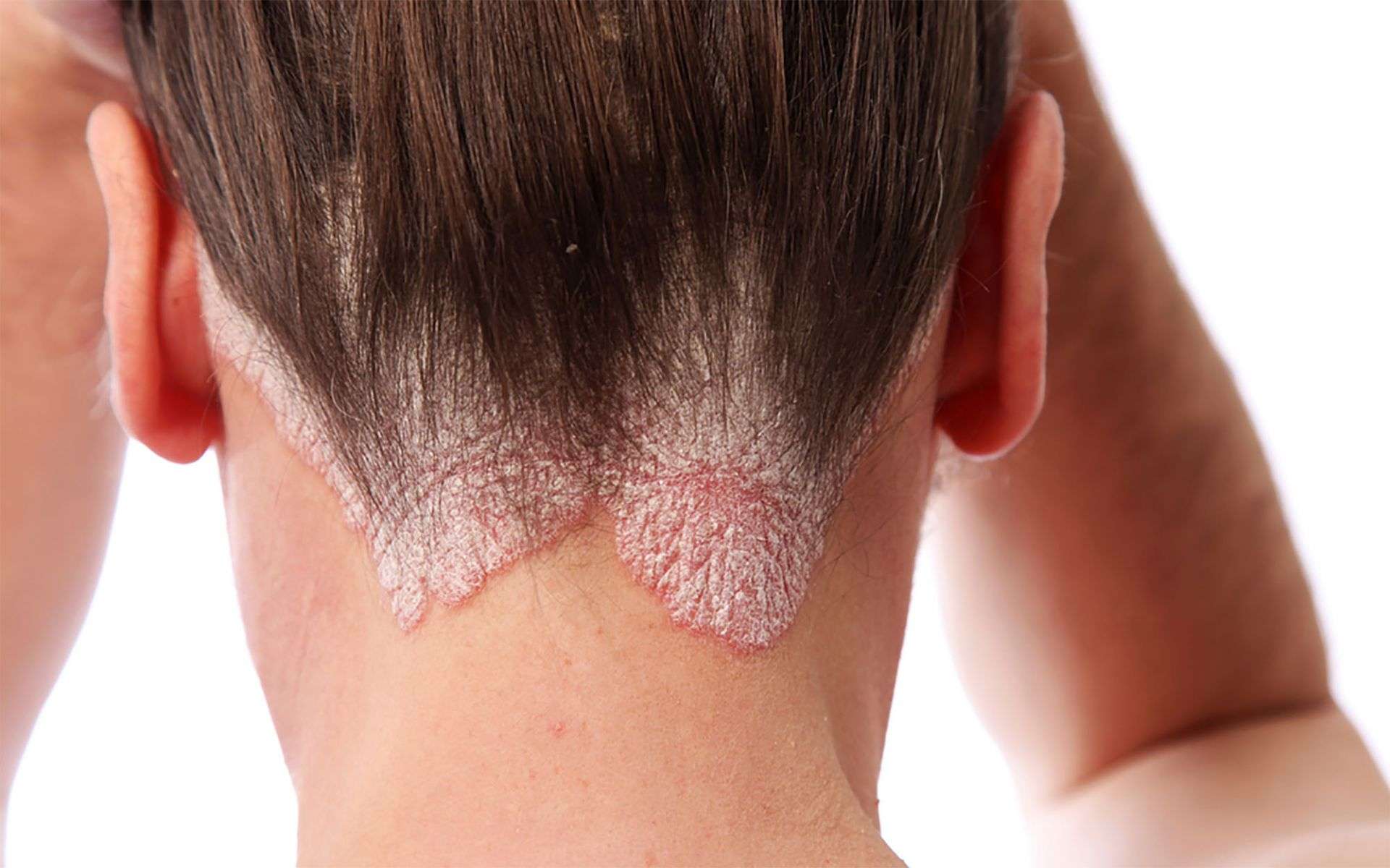 psoriasis on upper neck of patient