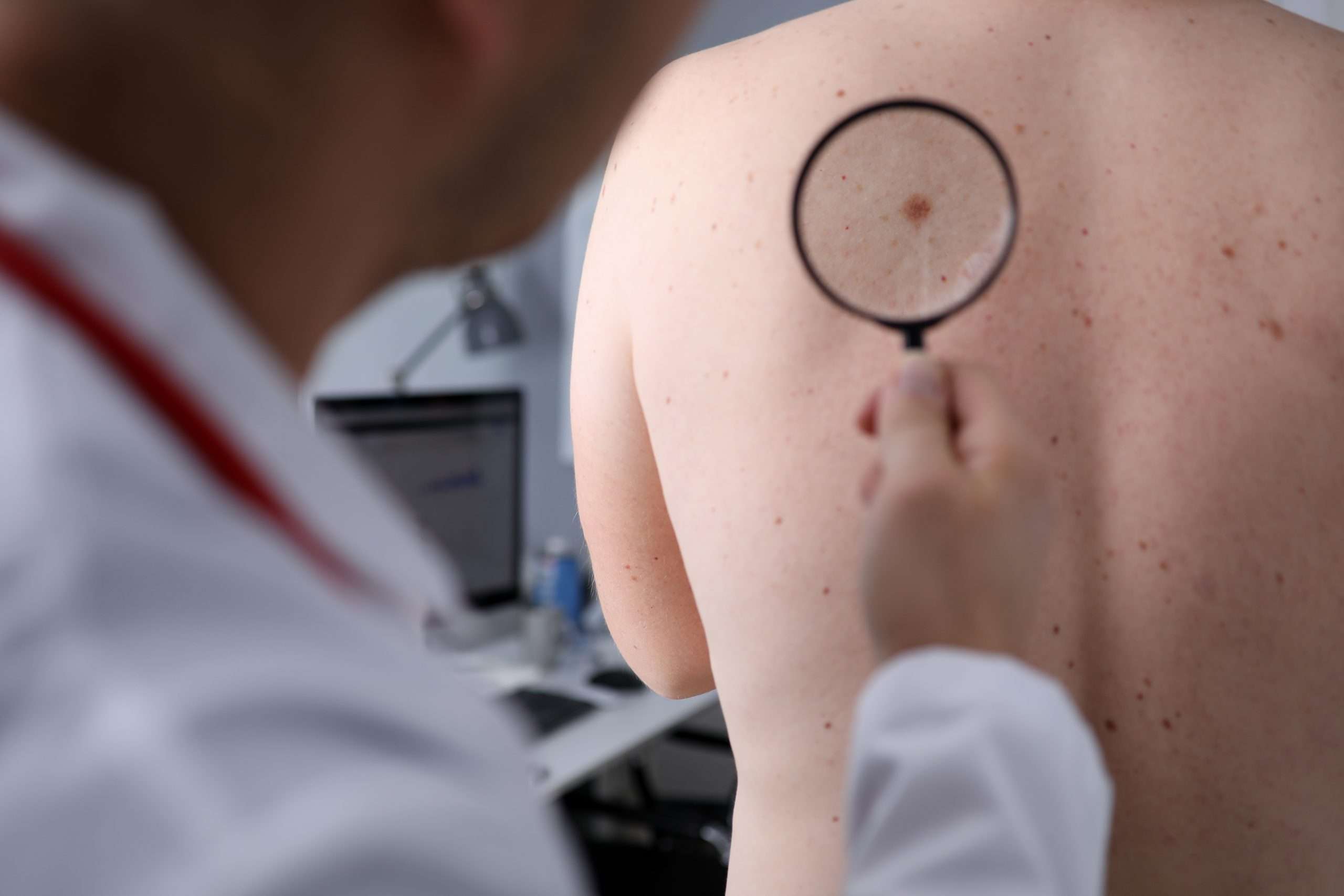 dermatologist checking birthmarks on patient's back