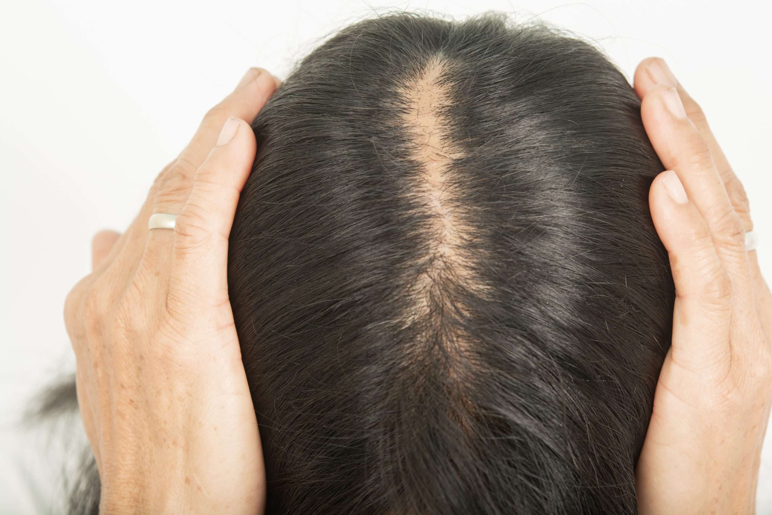 women with thinning hair being evaluated for hair growth treatment