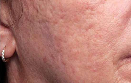 Before-Courtesy of Guy Cappucino, MD