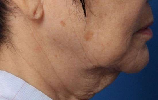 Before-Courtesy of JW Choi, MD