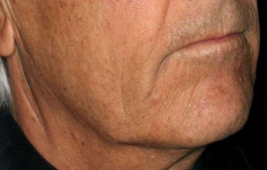 Before-Courtesy of Matteo T. Clementoni, MD