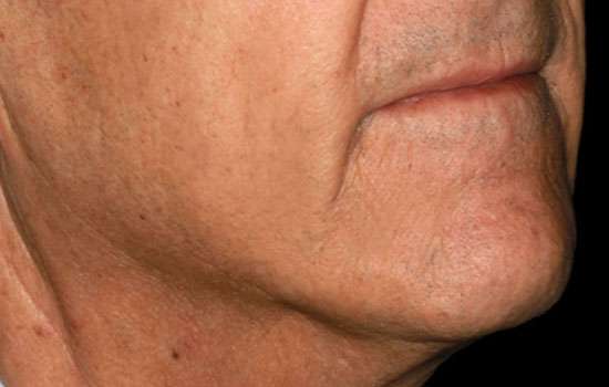 After-Courtesy of Matteo T. Clementoni, MD