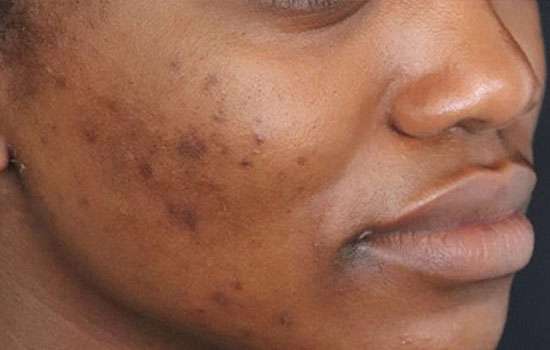 Before-Courtesy of Zena Gabriel, MD