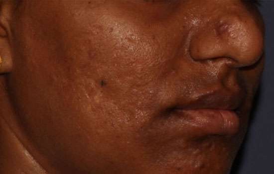 Before-Courtesy of Swapnil Shah, MD