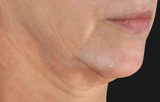 Before-Courtesy of Steven Weiner, MD