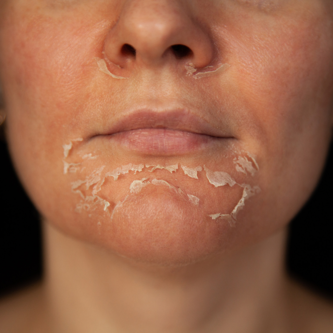 chemical peel for brighter skin