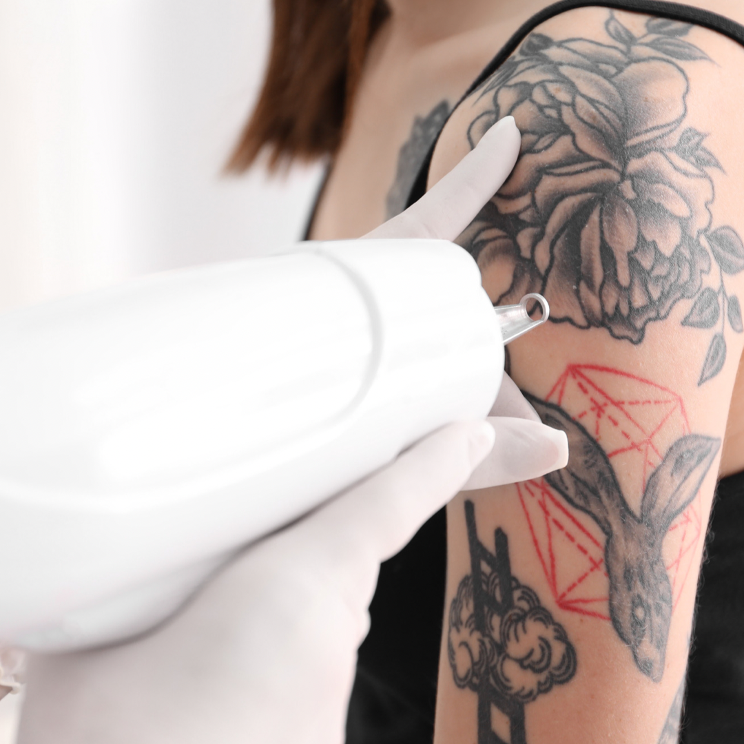 tattoo removal services in alabama