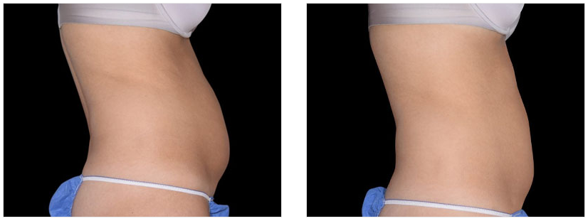 georgia women before and after liposuction