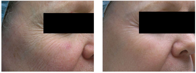 fractional laser resurfacing on patients face
