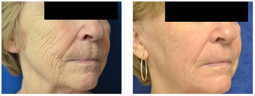 patient before and after fractional laser resurfacing procedure