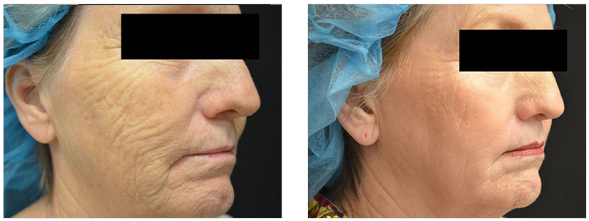 before and after of fractional laser resurfacing