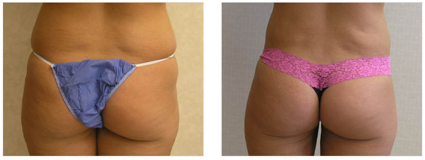 Wrinkle Treatment in Macon