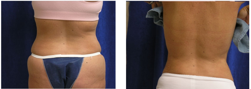 Macon Wrinkle Treatment