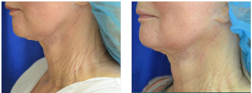 non-surgical facelift in macon, ga before and after