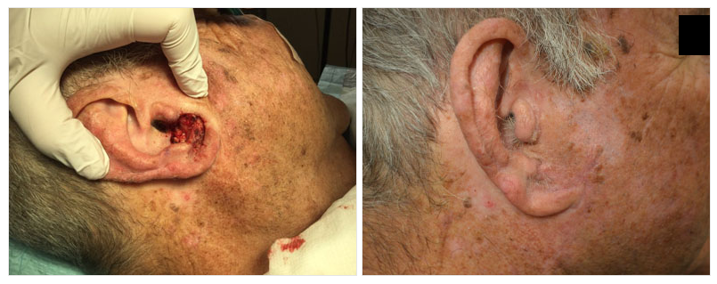 example of mohs surgery on ear