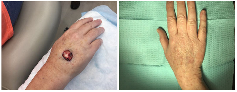 skin cancer on hand