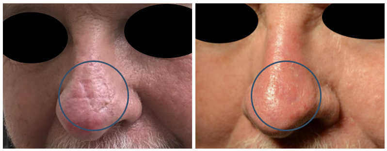 mohs surgery on nose
