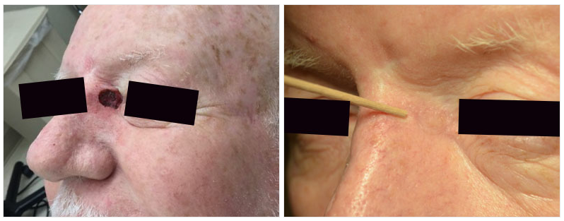 before and after surgery for skin cancer near brow