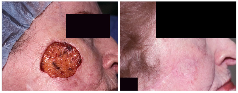 before and after mohs surgery