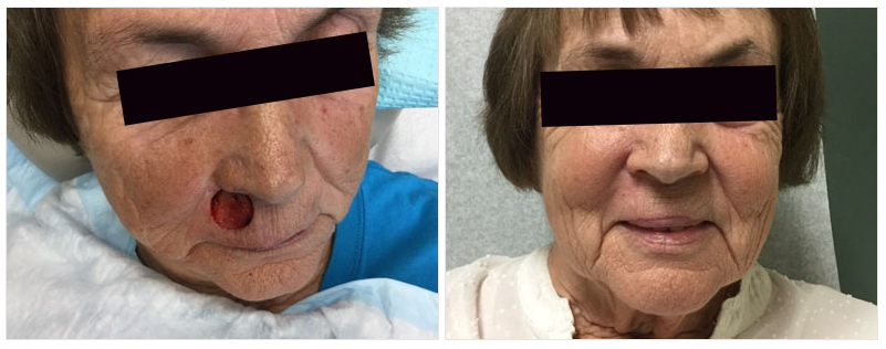 patient treated for spot under nose