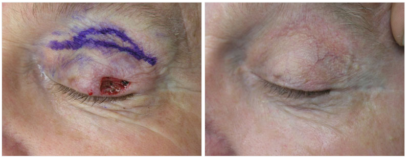 mohs surgery on eyelid