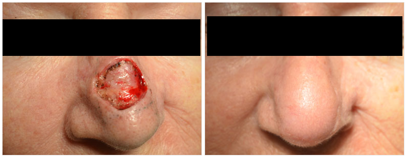 skin cancer on nose