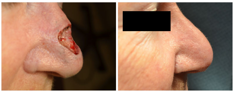 before and after of mohs surgery on nose