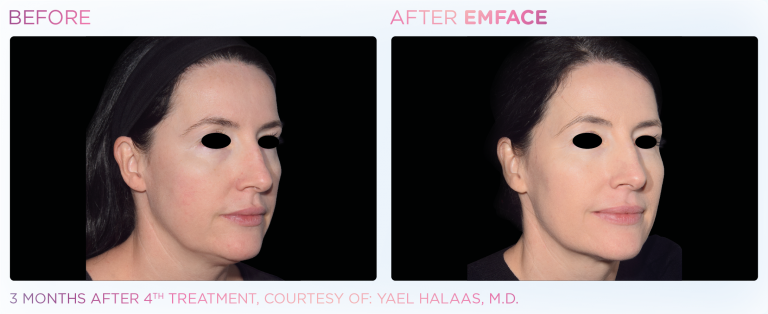 before and after example of patient after emface procedure