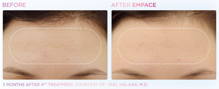 emface procedure on forhead