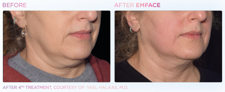 before and after emface treatment