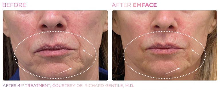 emface around lips of women