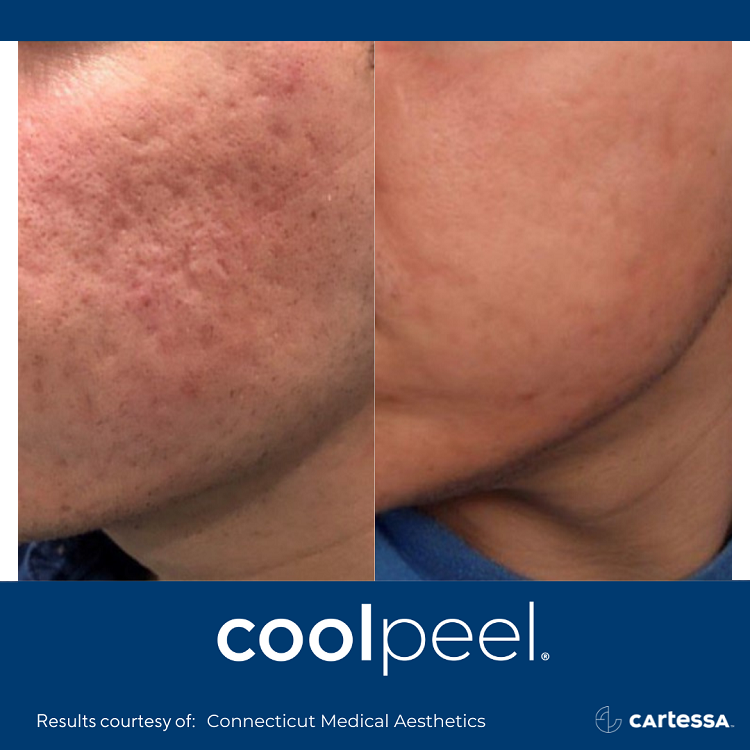 coolpeel® treatments in ga