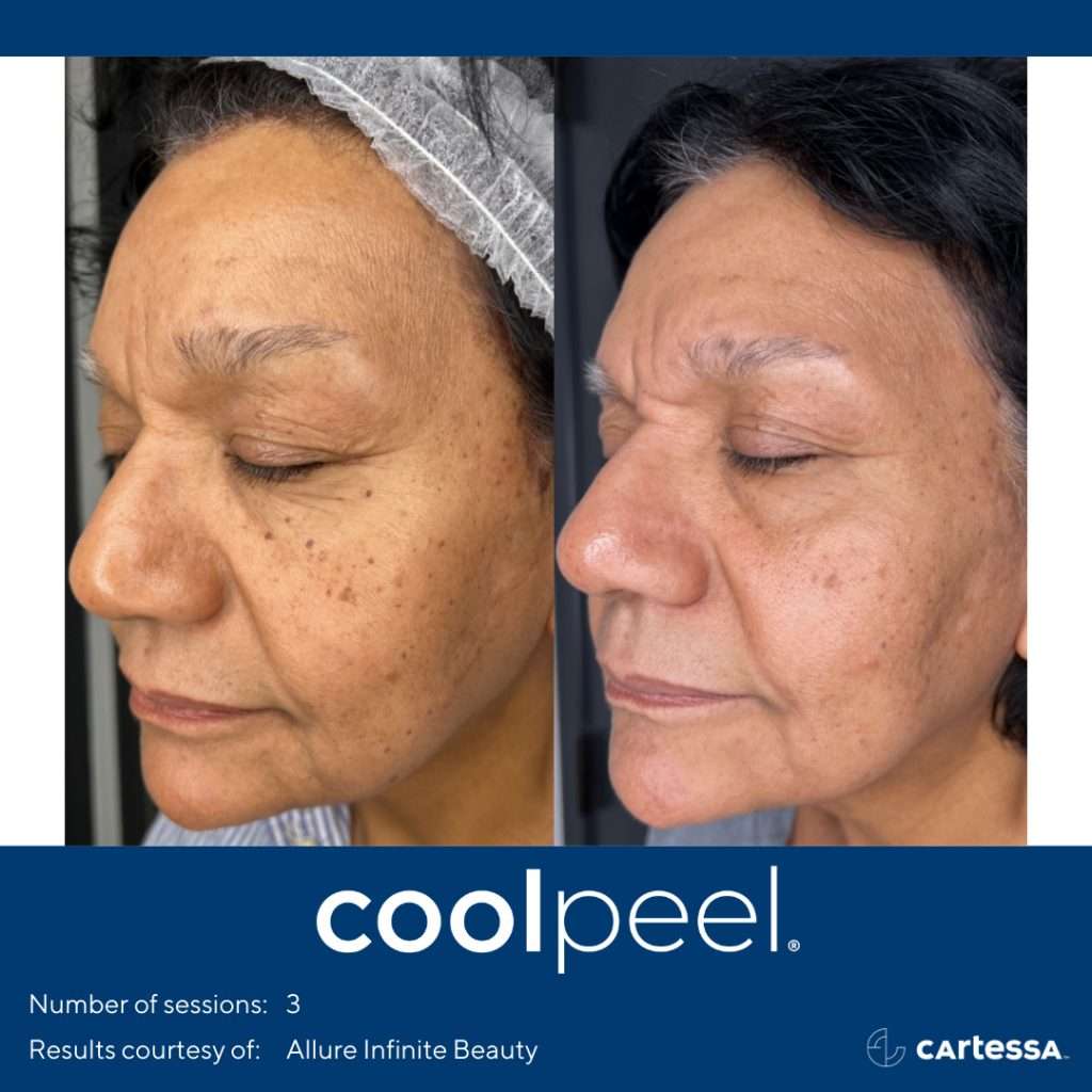 how coolpeel works