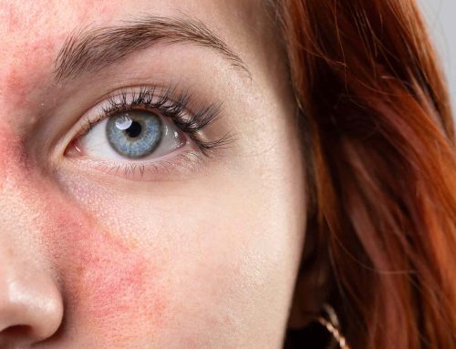 Rosacea Awareness Month: Understanding, Managing, and Treating This Common Skin Condition