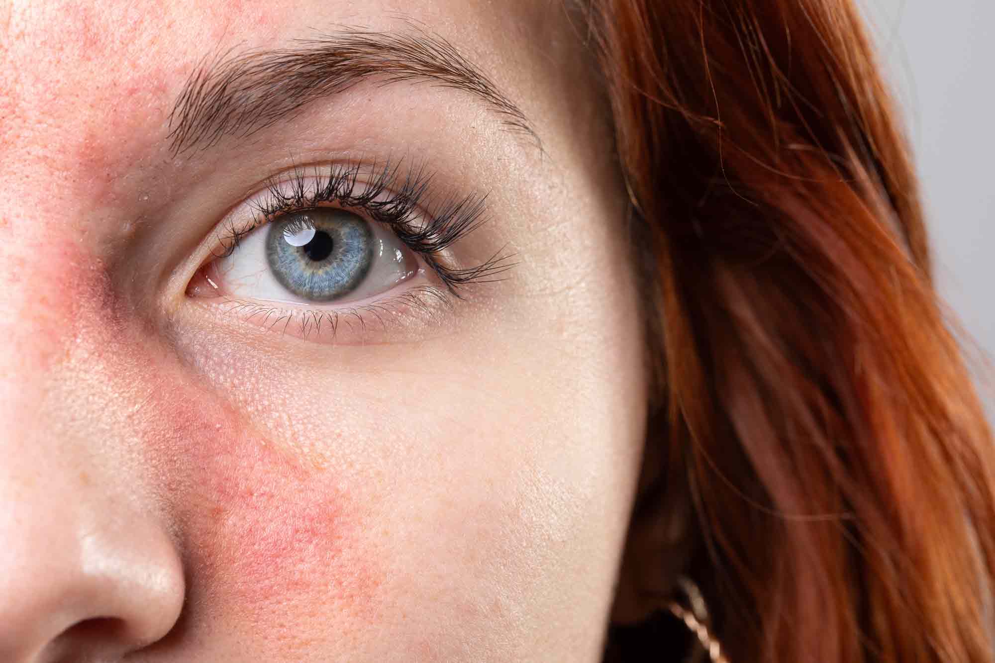 woman with rosacea on her face